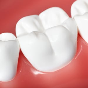 porcelain veneers houston